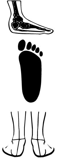 pisada pronada