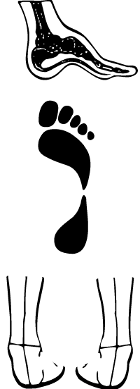 pisada supinada
